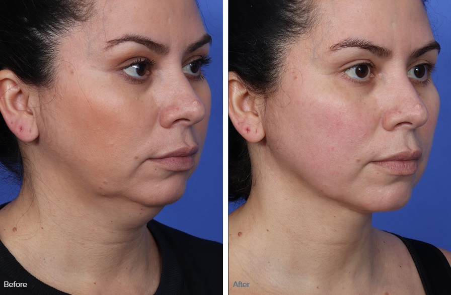 myellevate minimally invasive neck and facelift before and after