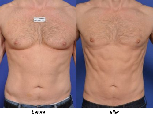 Emsculpt for abs before and after