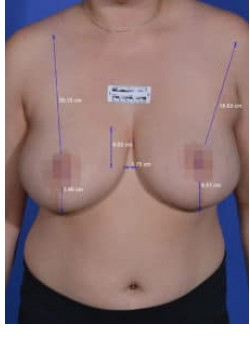 Non-surgical Breast Lift Before & After Image