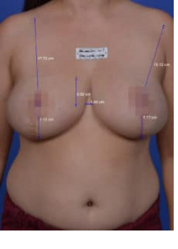 Non-surgical Breast Lift Before & After Image