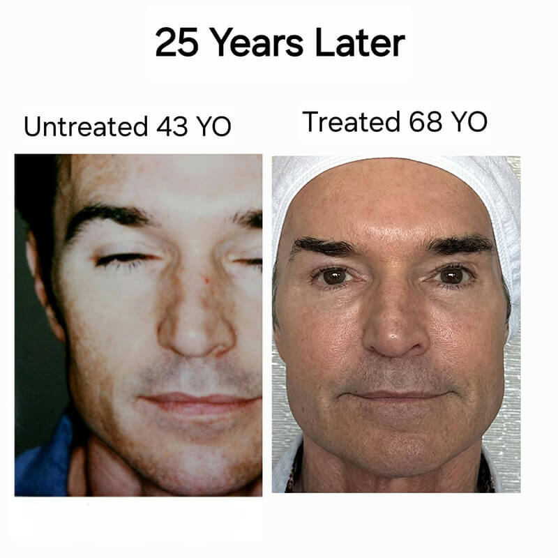 before & after Forever Young BBL vs. Sciton Moxi