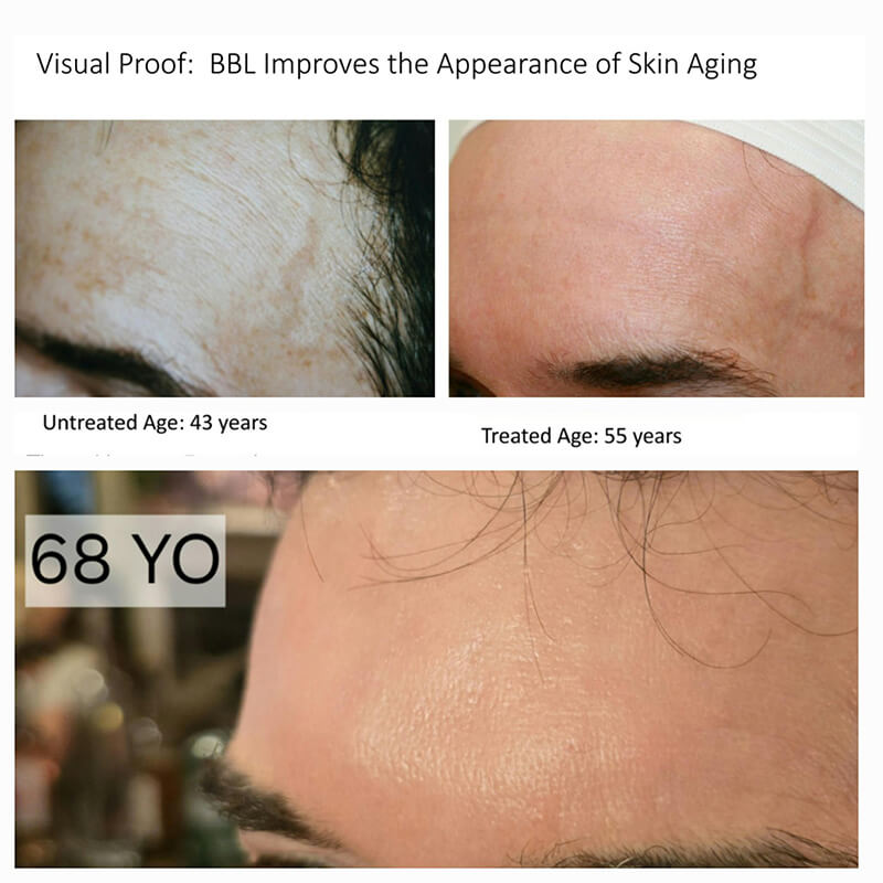 before & after Forever Young BBL vs. Sciton Moxi