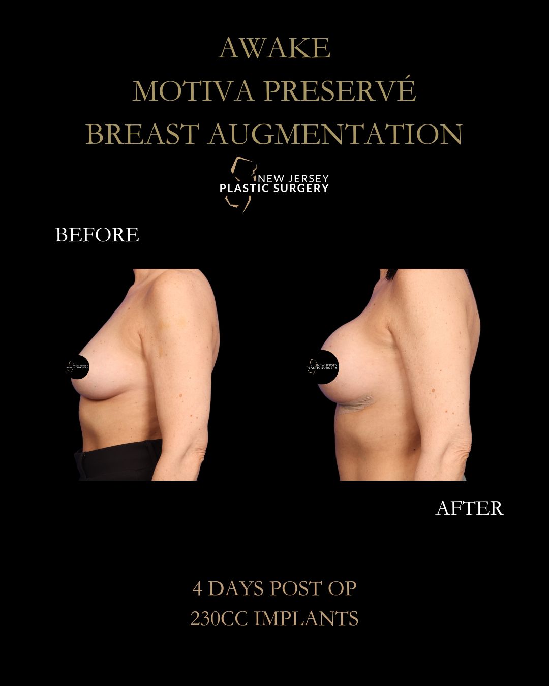 Preservation Breast Augmentation gallery image