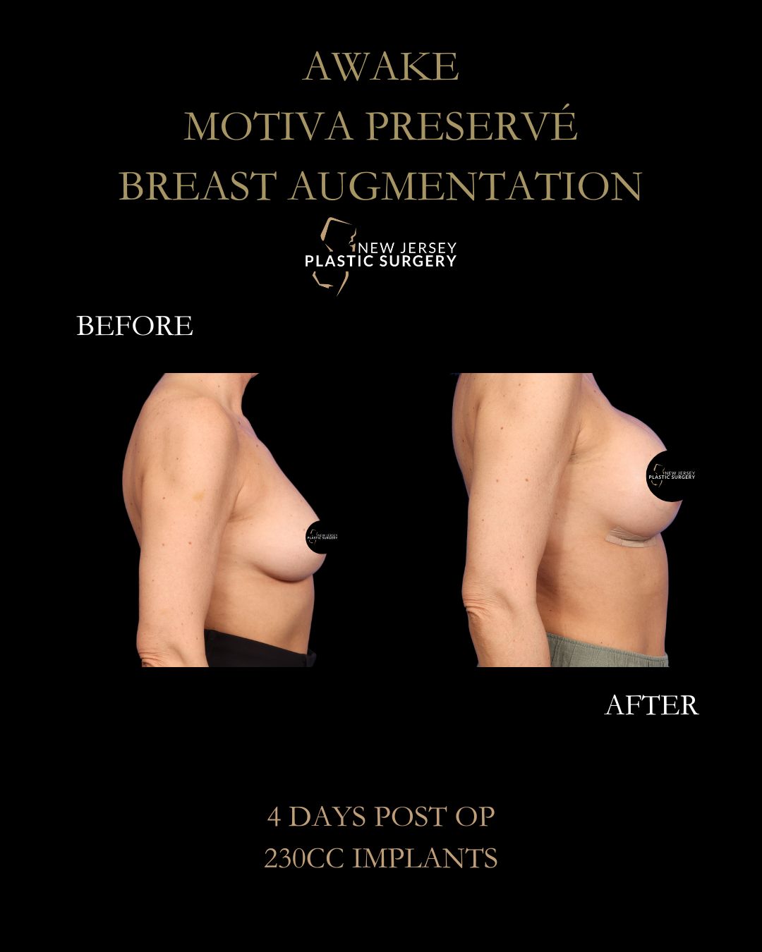 Preservation Breast Augmentation gallery image