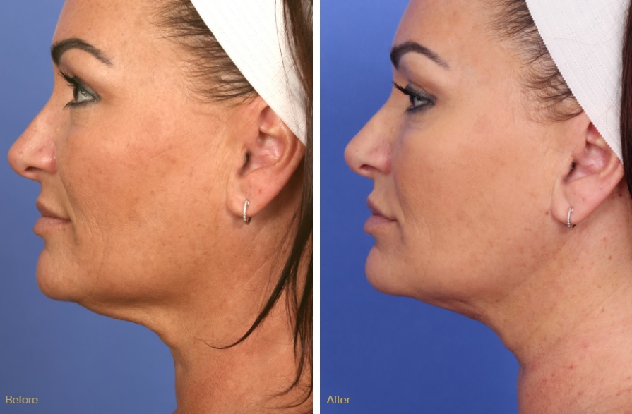 facetite minimally invasive facelift before and after