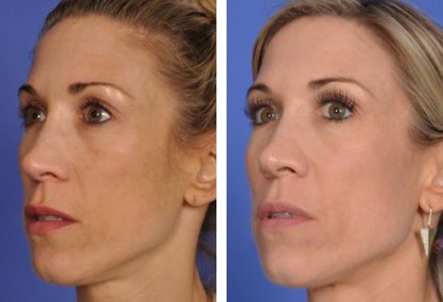 before and after photo of a patient who has had halo laser treatment for sun damage