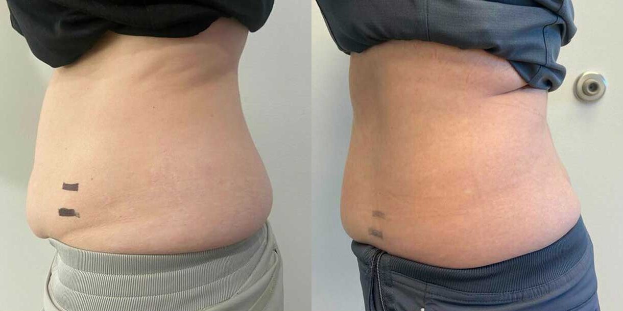 before and after of a mommy makeover patient