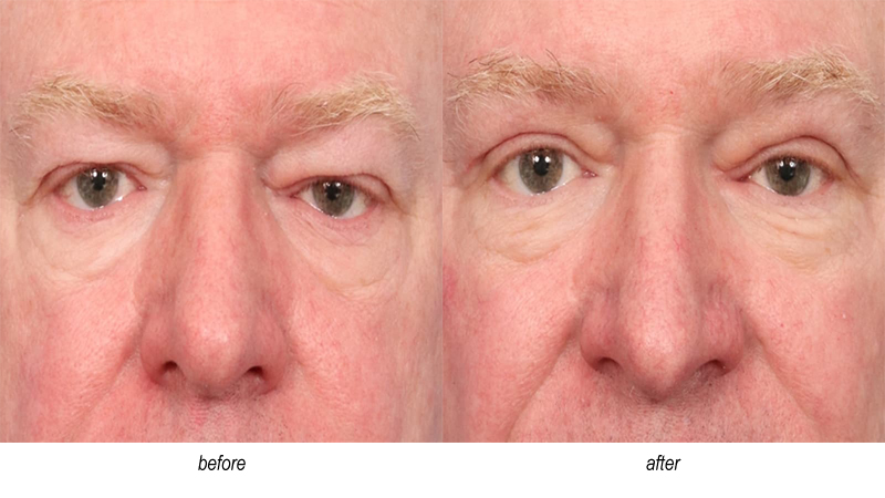 before and after blepharoplasty for men