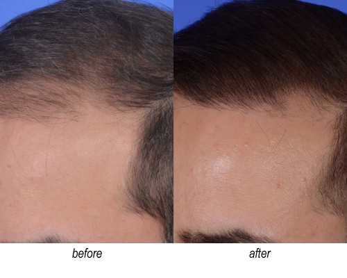 before and after hair transplant