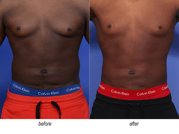 before and after liposuction plastic surgery for men