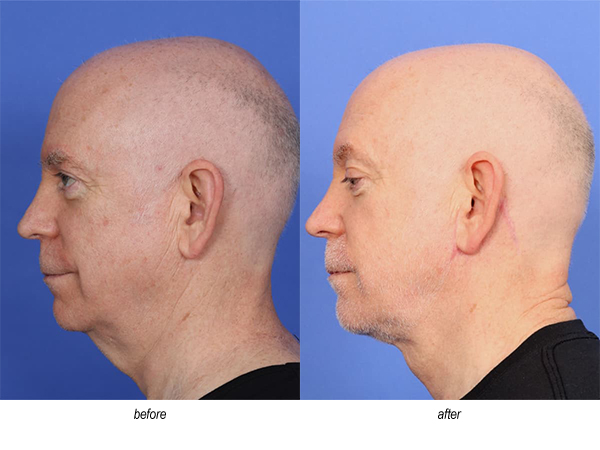 before and after myellevate neck lift for men