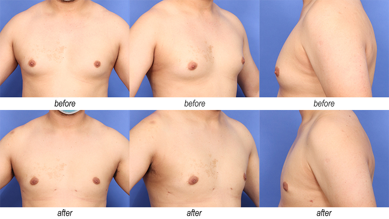 male breast reduction before and afters