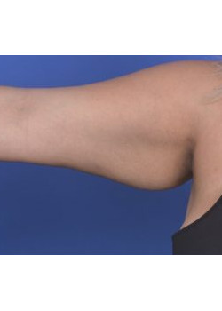 Brachioplasty Before & After Image