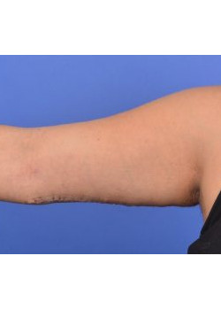 Arm Lift Before & After Image
