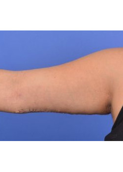 Brachioplasty Before & After Image