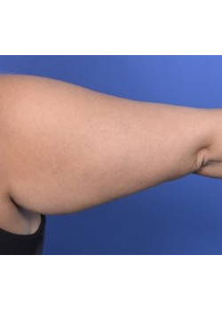 Brachioplasty Before & After Image
