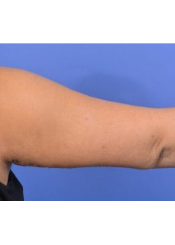 Brachioplasty Before & After Image
