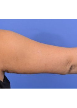 Brachioplasty (Arm Lift) Before & After Image