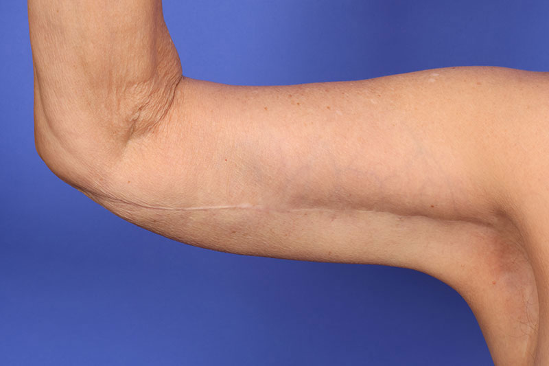 Brachioplasty (Arm Lift) Before & After Image