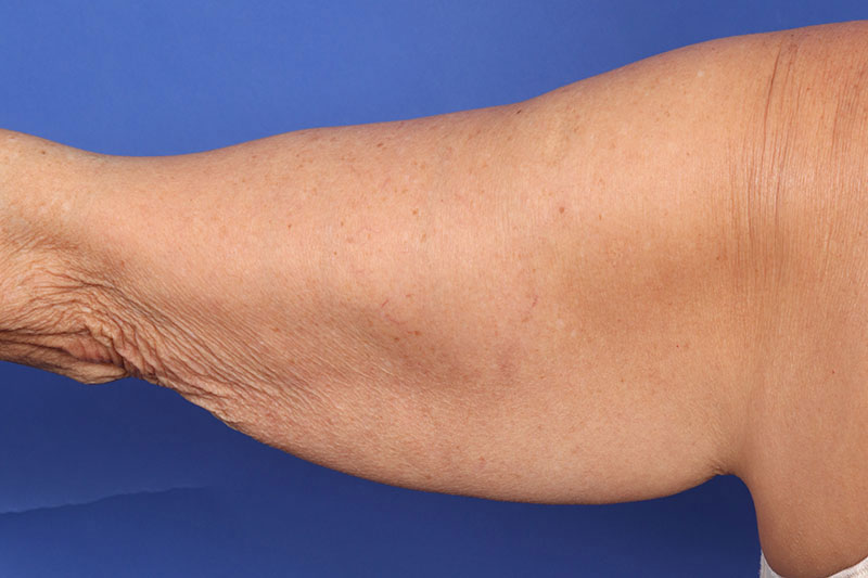 Brachioplasty (Arm Lift) Before & After Image