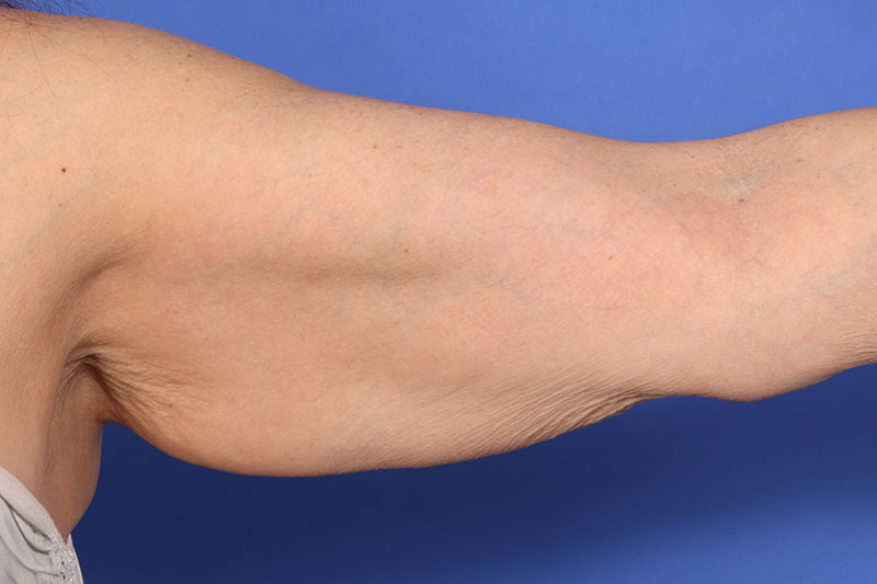 Brachioplasty Before & After Image
