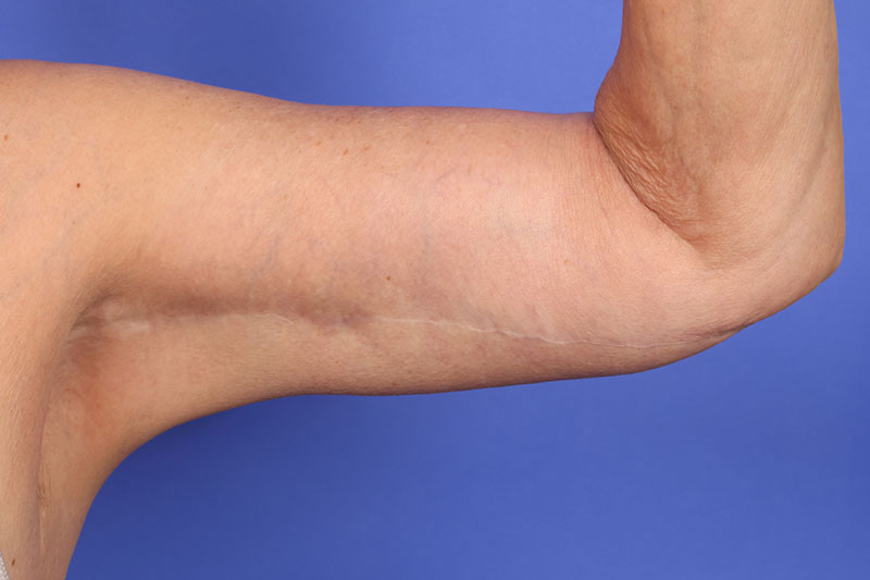 Brachioplasty Before & After Image