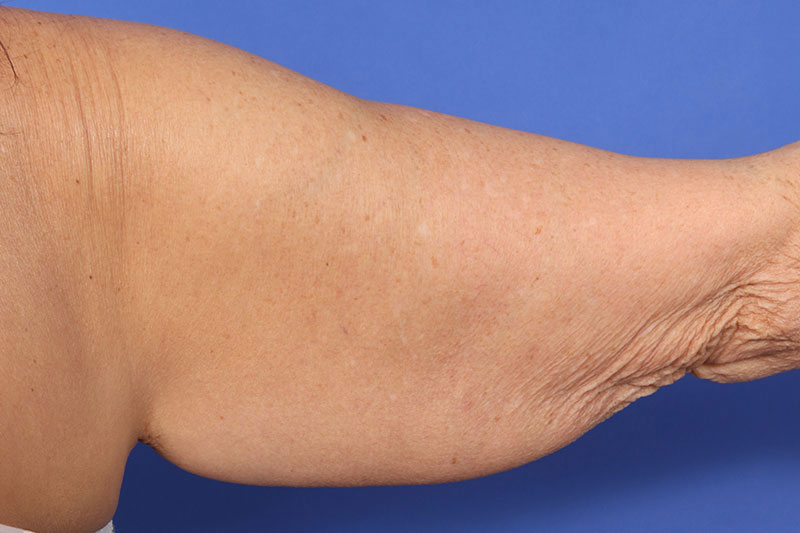 Brachioplasty Before & After Image