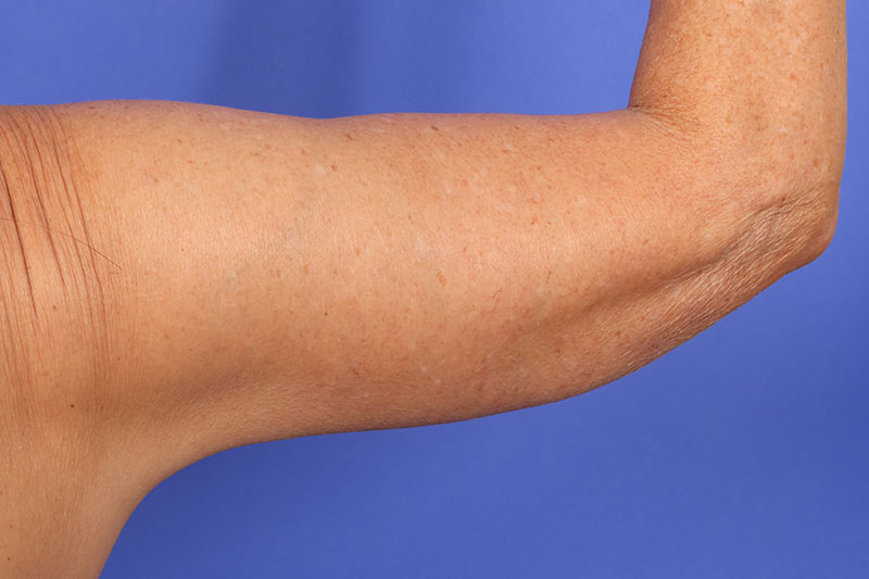 Brachioplasty Before & After Image