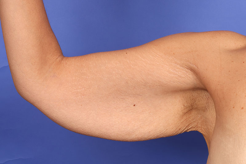 Brachioplasty Before & After Image