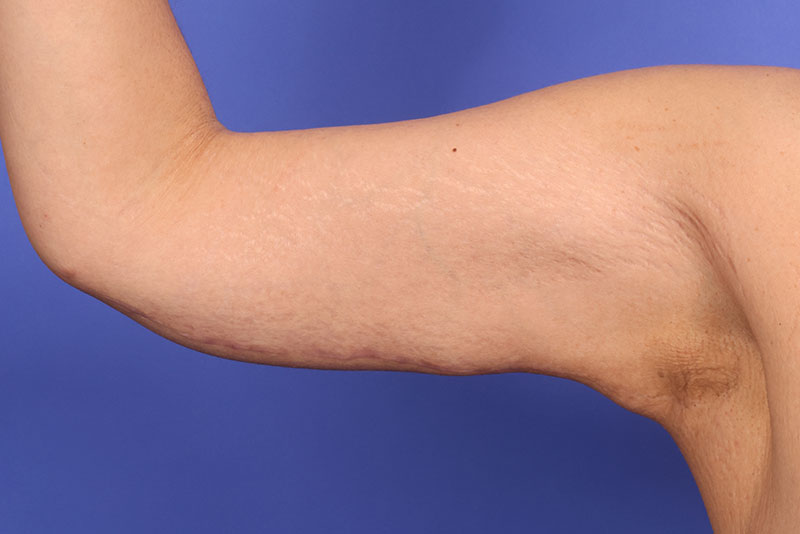 Brachioplasty Before & After Image