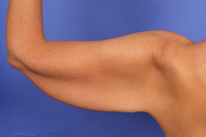 Brachioplasty Before & After Image