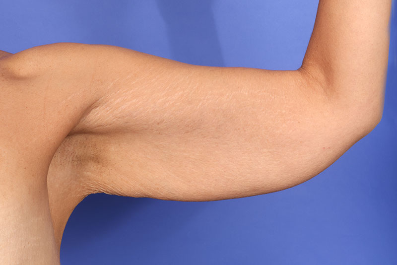 Brachioplasty Before & After Image