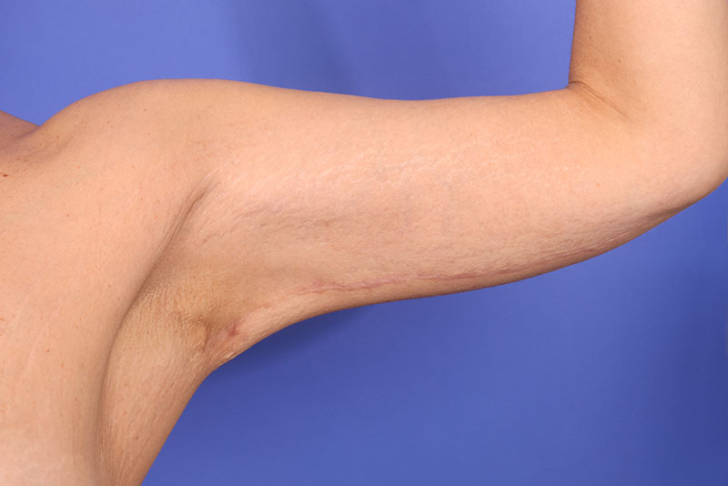 Brachioplasty Before & After Image
