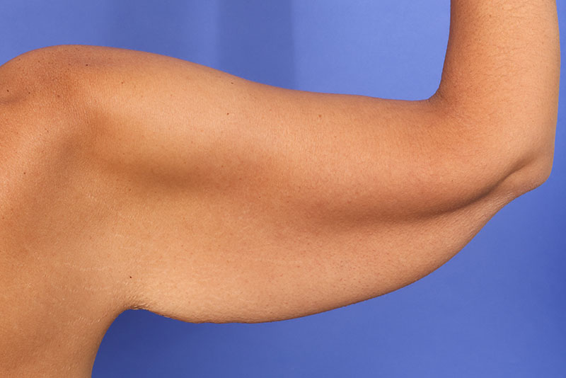 Brachioplasty Before & After Image