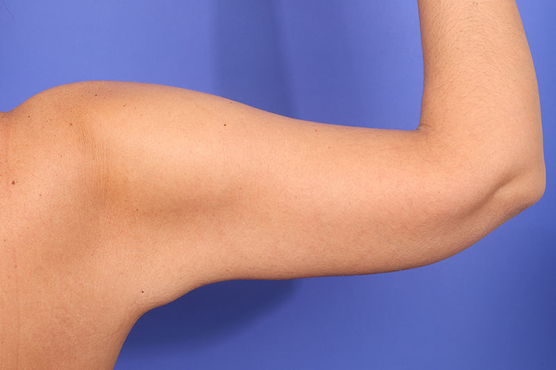 Brachioplasty Before & After Image