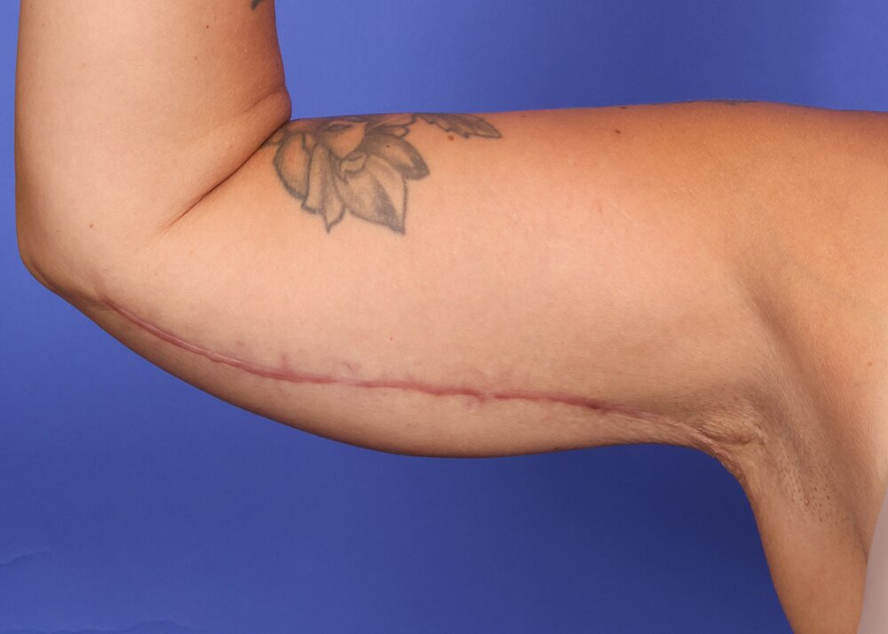 Brachioplasty Before & After Image