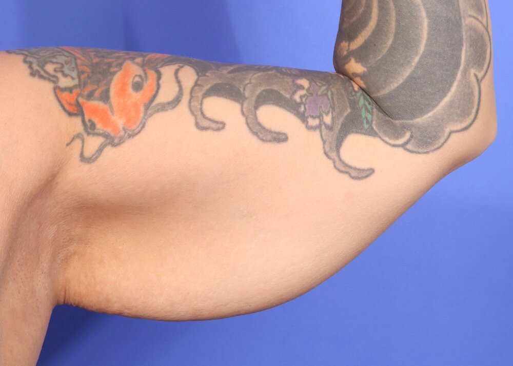 Brachioplasty Before & After Image