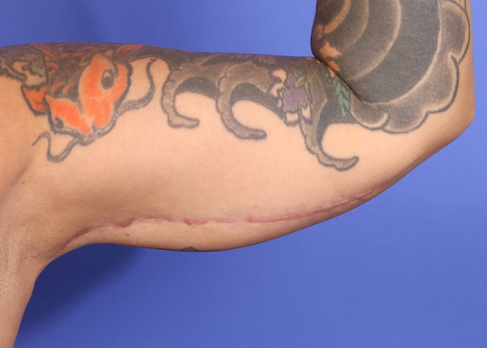Brachioplasty Before & After Image