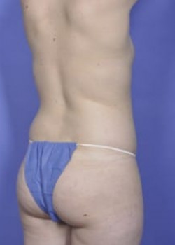 Brazilian Butt Lift Before & After Image