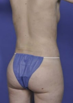 Brazilian Butt Lift Before & After Image