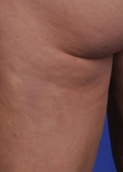 Cellulaze Before & After Image