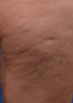 Cellulaze Before & After Image