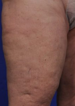 Cellulaze Before & After Image