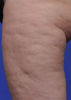 Cellulaze Before & After Image