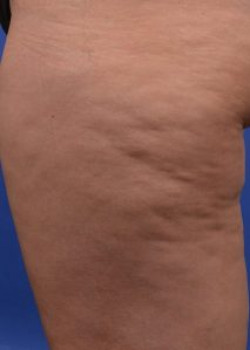 Cellulaze Before & After Image