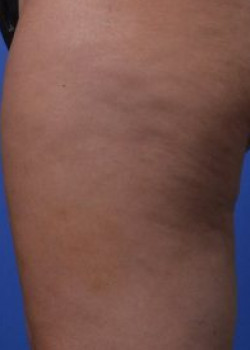 Cellulaze Before & After Image