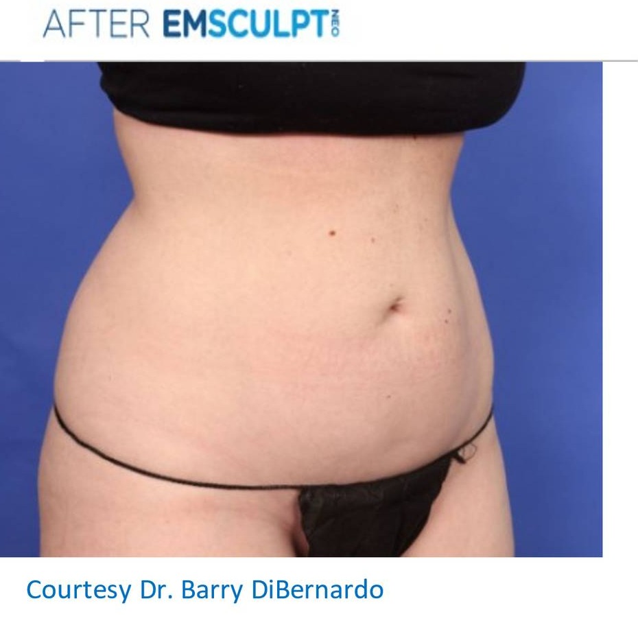 EmSculpt Neo Edge Before & After Image