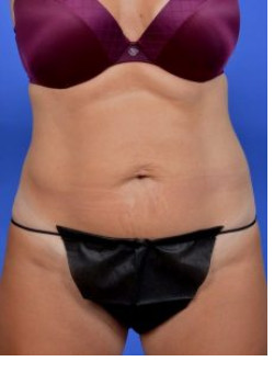 EmSculpt Before & After Image