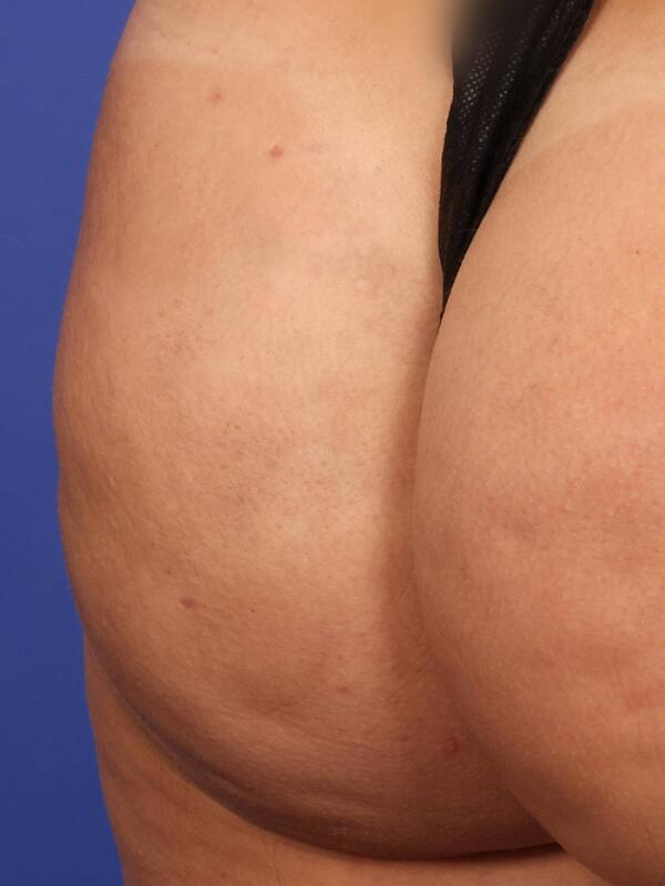 Fat Grafting Before & After Image