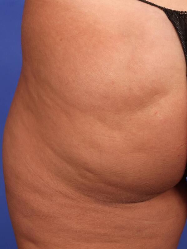 Fat Grafting Before & After Image